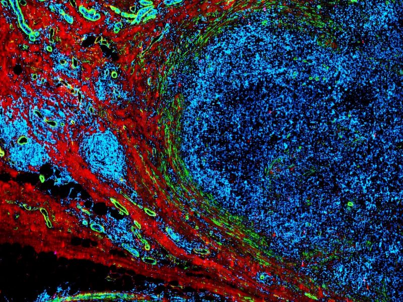  A breast tumor (blue) grows within the surrounding mammary tissue (red), while lymphatic vessels (green) form a network around it.